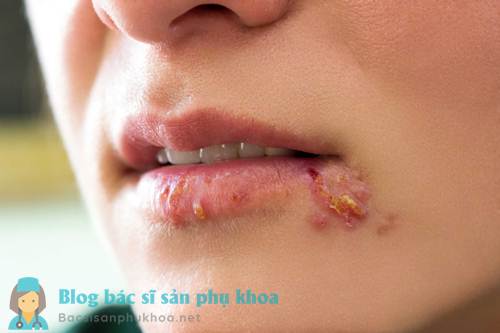 Virus Herpes gây bệnh ở niêm mạc miệng, mắt và bộ phận sinh dục