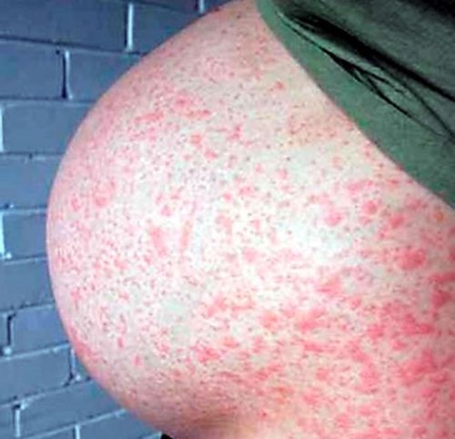 Nhiễm virus rubella khi mang thai