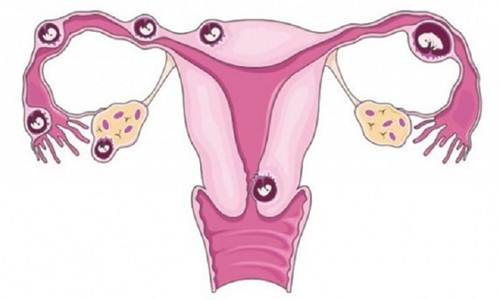 Thắt ống dẫn trứng làm tăng nguy cơ mang thai ngoài tử cung