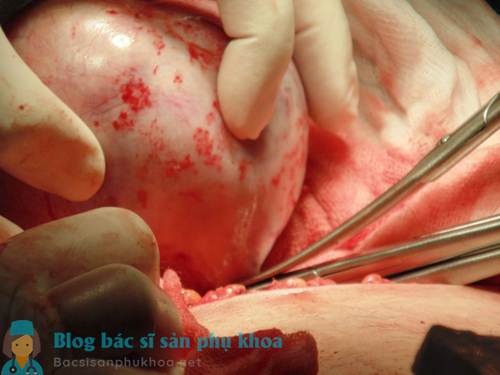 Phẫu thuật loại bỏ u nang buồng trứng