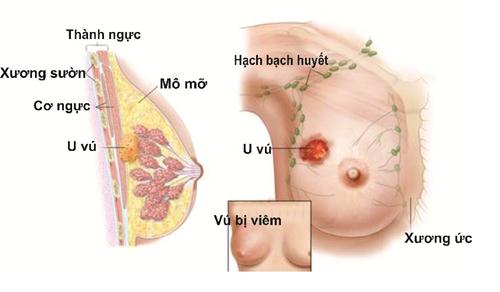 U xơ tuyến vú là bệnh phổ biến ở phụ nữ ngoài 30 tuổi