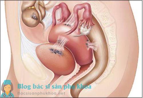 Lạc nội mạc tử cung gây vô sinh ở phụ nữ